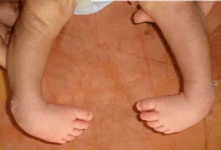 BEST PEDIATRIC ORTHOPEDIC SURGEON,child orthopedic surgeon in morbi