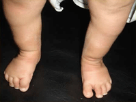 pediatric orthopedic doctor in satellite, child orthopedic doctor in bhavnagar