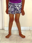pediatric orthopedic doctor in satellite, PEDIATRIC ORTHOPEDIC SURGERY DOCTOR PRAHLAD NAGAR