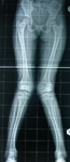 PEDIATRIC ORTHOPEDIC HOSPITAL IN NARANPURA , child orthopedic specialist doctor in satellite