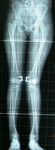 PEDIATRIC KNEE REPLACEMENT SURGEON IN AHMEDABAD, CHILD ORTHOPEDIC DOCTOR VIJAY CROSS ROAD