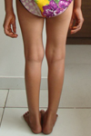 BEST PEDIATRIC ORTHOPEDIC SURGEON , CHILD ORTHOPEDIC HOSPITAL SHYAMAL SATELLITE