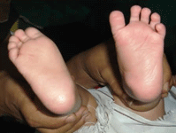 Pediatric Orthopedic In Gujarat, Children Orthopedic Surgeon In Rajasthan