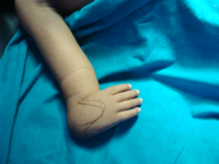 child orthopedic doctor in palanpur, BEST PEDIATRIC ORTHOPEDIC SURGEON