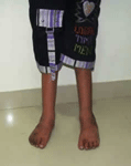 pediatric orthopedic doctor in satellite, CHILD ORTHOPEDIC DOCTOR AMBALI