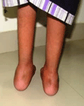 pediatric orthopedic doctor in satellite, PEDIATRIC ORTHOPEDIC HOSPITAL IN NARANPURA